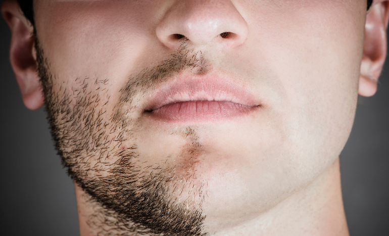 Laser facial hair removal men